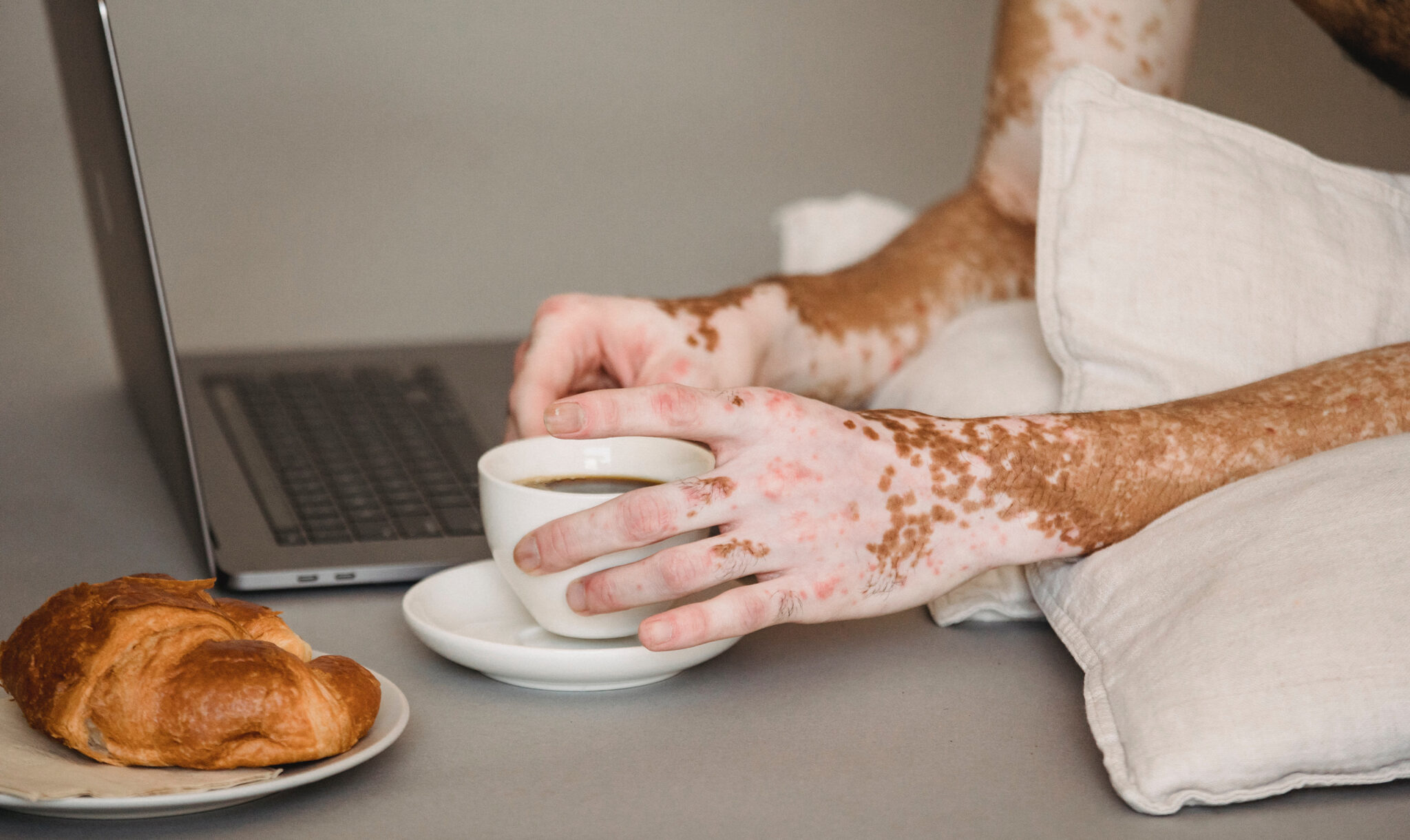 Les traitements du vitiligo - Association Française du Vitiligo